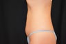 CoolSculpting Before and After Lower Abdomen