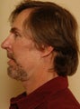 Chin Implant
