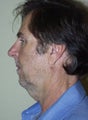 Chin Implant