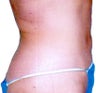 Smart Lipo