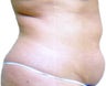 Smart Lipo