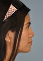 Young Asian female underwent Non-surgical Rhinoplasty