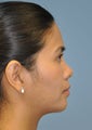 Young Asian female underwent Non-surgical Rhinoplasty