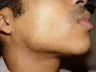 Gentlemen's Choice - Razor Bump Laser Hair Removal