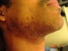 Gentlemen's Choice - Razor Bump Laser Hair Removal