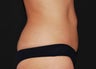 CoolSculpting