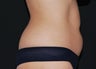 CoolSculpting
