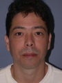 Chin Augmentation, Chin Surgery