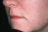 Lip Augmentation