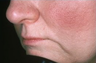 Lip Augmentation