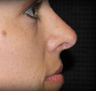 Rhinoplasty
