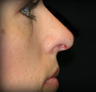 Rhinoplasty