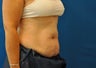 CoolSculpting