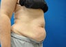 CoolSculpting