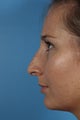 Non-surgical Rhinoplasty