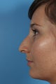 Non-surgical Rhinoplasty