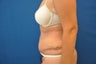 Tummy Tuck