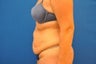 Tummy Tuck