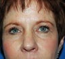 upper blepharoplasty