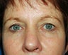 upper blepharoplasty