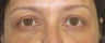 Bilateral upper lid mild ptosis, upper and lower lid dermatochalasia (excess skin) and fat prolapse