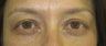 Bilateral upper lid mild ptosis, upper and lower lid dermatochalasia (excess skin) and fat prolapse