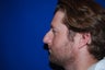Rhinoplasty