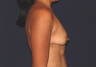 Breast Augmentation