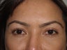 Eyebrow transplant