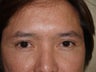 Eyebrow transplant