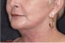 Chin implant, SMAS to lips, facelift