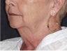 Chin implant, SMAS to lips, facelift