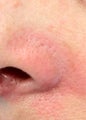 Laser treatment of nose veins and superficial spider veins