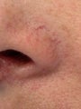 Laser treatment of nose veins and superficial spider veins