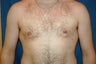 gynecomastia correction