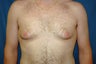 gynecomastia correction