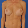 Breast Revision