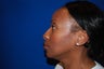 Rhinoplasty