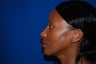 Rhinoplasty