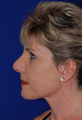 Nose Surgery