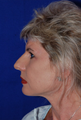 Nose Surgery