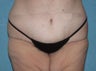 Circumferential Body Lift with Buttock Augmentation