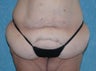 Circumferential Body Lift with Buttock Augmentation
