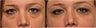 Los Angeles Microcannula Injection - Belotero and Juvederm to Cheeks and Tear Troughs