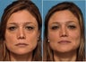 Los Angeles Microcannula Injection - Belotero and Juvederm to Cheeks and Tear Troughs