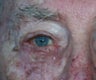 87 year old male treated for ectropion