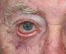 87 year old male treated for ectropion