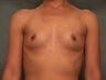 Silicone gel implants