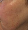 67 year old female with unwanted pigmentary changes on face