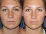 Before & After Fraxel Restore